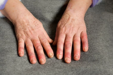 U SRBIJI NA SVAKIH 20 MINUTA JEDNA OSOBA OBOLI OD OVE BOLESTI: Prve simptome možete videti na RUKAMA!