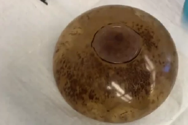 IZ ŽENE IZVADILI "PRLJAVE" SILIKONE, LEKARI ZGROŽENI! Izgledala neprepoznatljivo, odmah dobila DIJAGNOZU! (FOTO/VIDEO)