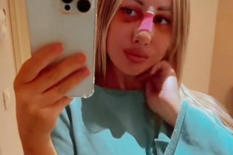 Maca Diskrecija operacija nosa