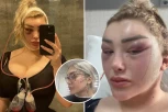 ZVEZDI "ONLY FANS" SE OTVORILI ŠAVOVI U AVIONU: Glava joj eksplodirala od pritiska zbog operacije mačijih očiju, preživela pakao! (VIDEO)