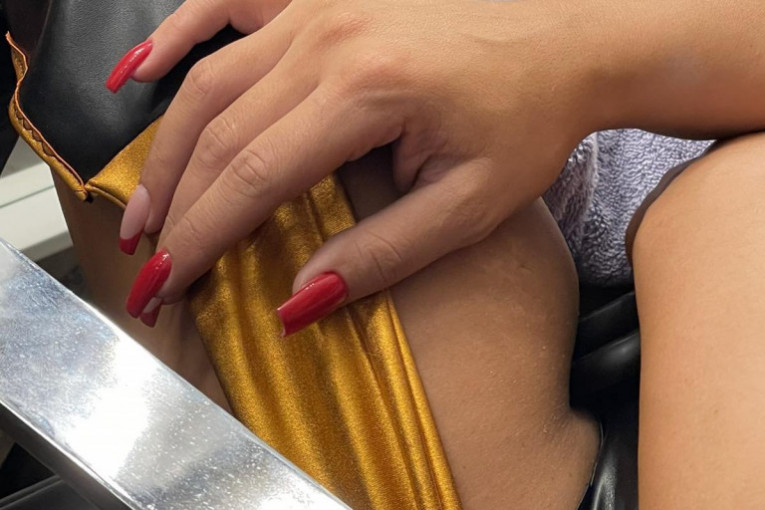 Marijana Zonjić-opekotine 