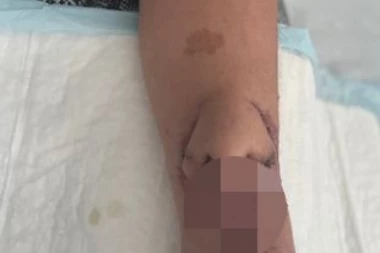RASTE JOJ NOS NA RUCI! Lekari joj jedan odstranili, pa napravili novi, a ona OSAM godina nije izlazila iz kuće!