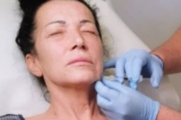 ISKUSTVO IZ PAKLA! Naša pevačica otišla na BOTOKS, a kad je videla lice, IZBEZUMILA SE - NIJE MOGLA DA SE PREPOZNA!