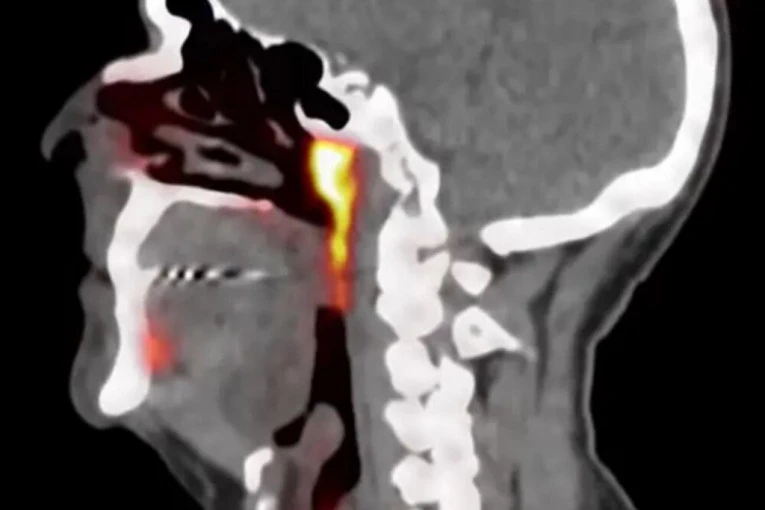 NAUČNICI ISPITIVALI RAK PROSTATE, PA OTKRILI NOVI ORGAN! Pacijentima zadaje glavobolje, posebno se odnosi na ZRAČENJE