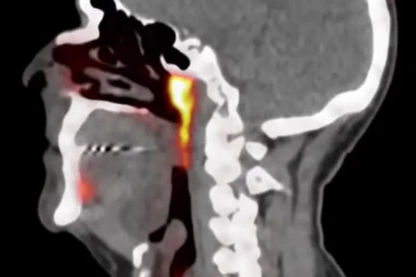 NAUČNICI ISPITIVALI RAK PROSTATE, PA OTKRILI NOVI ORGAN! Pacijentima zadaje glavobolje, posebno se odnosi na ZRAČENJE