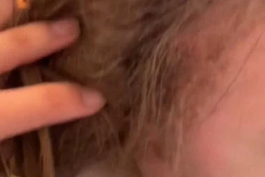 NOVA TRAGEDIJA! Devojčica (3) umrla nakon što je majka pokušala da joj ukloni VAŠKE! Sestra (8) u teškom stanju!