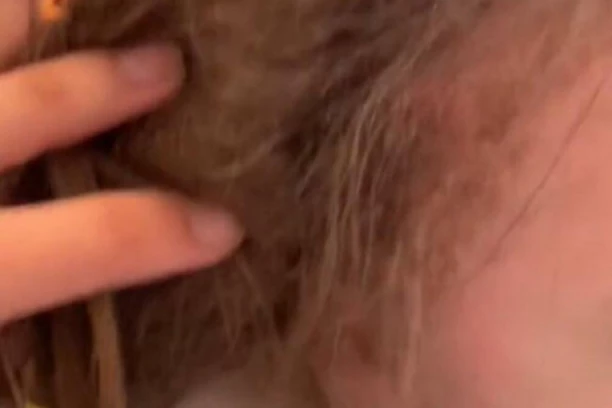 NOVA TRAGEDIJA! Devojčica (3) umrla nakon što je majka pokušala da joj ukloni VAŠKE! Sestra (8) u teškom stanju!