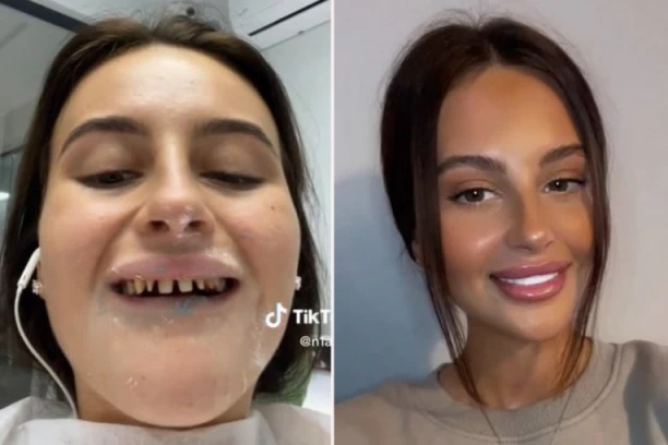 KAO DA IMAŠ PLOČICE ZA KLAVIR: Uradila turske zube, pa pokazala šta je ostalo od njenih - JEZIVO!