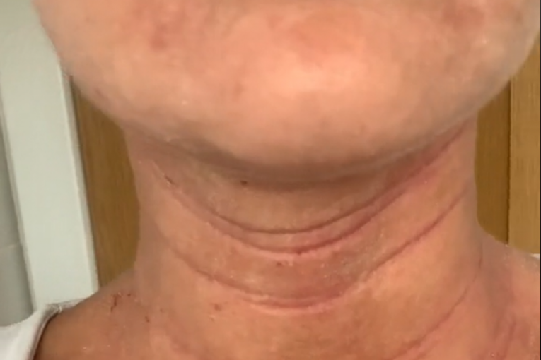 Posledice kreme vidljive i na vratu