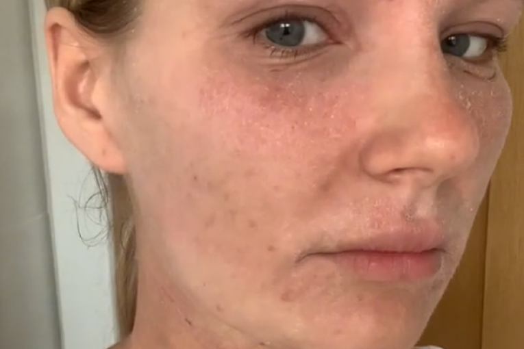 Spaljena koža nakon kreme