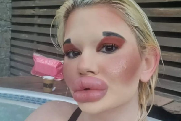 BUGARSKA BRATZ LUTKA POSLE NAJVEĆIH USANA POSTAVLJA NOVI REKORD U SVETU: Lekari ne mogu da je ZUSTAVE, upozorovaju da će posledice biti FATALNE!