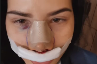 UKI Q U PODLIVIMA I MODRICAMA! Influenserka KRVAVA u bolničkom krevetu, otkrila šta se dogodilo! (FOTO)
