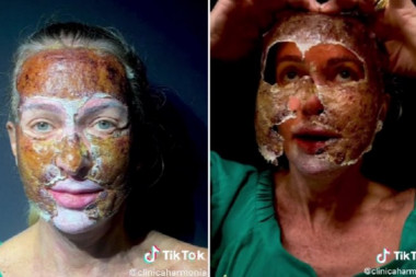 SKINULA KOŽU KAO DA JE IMALA OKLOP: Evo o kom tretmanu je reč, a lice ispod maske je JEZIVO (VIDEO)