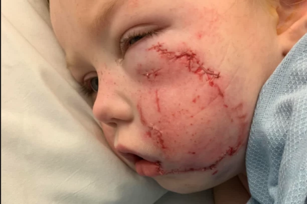 AMERIČKI BULDOG UMALO RASTRGAO DEVOJČICU (4)! Uhvatio je za lice i oborio na pod! Dete će imati trajne ožiljke! (FOTO)