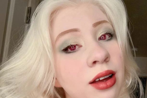 NJENA KOŽA I OČI NE PODNOSE SUNCE: Ova devojka boluje od RETKOG POREMEĆAJA, a užasni komentari NE STAJU - Evo kako se nosi sa tim