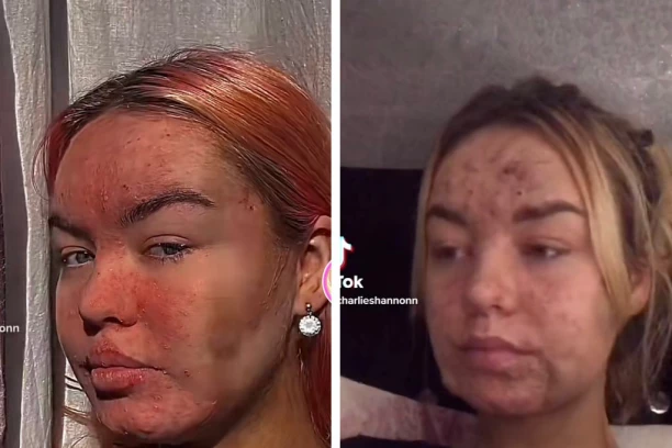 MISLILI SU DA JE ŽRTVA POŽARA, A ZAPRAVO JE KRIVA OVA  HRANA: "Govore mi da se ubijem, lekare je briga"  Onda je uradila krvnu sliku i saznala sa čime se stvarno BORI