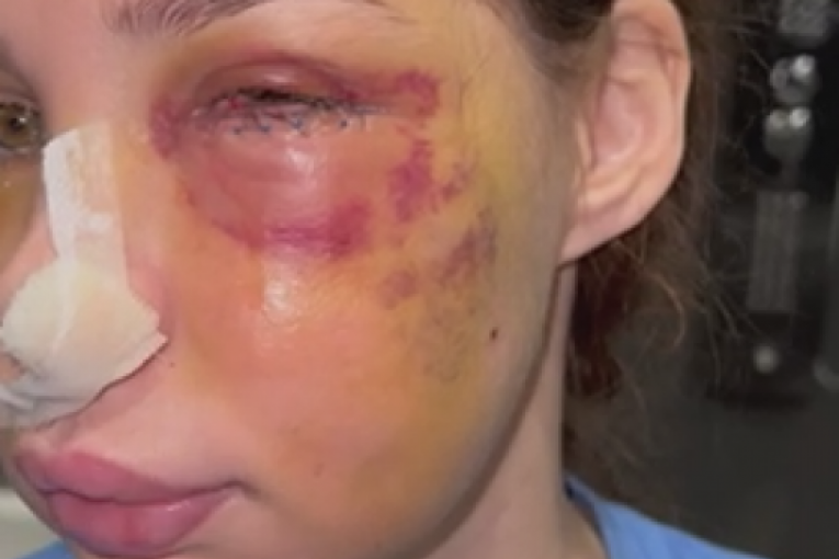 Pretučena Nataša Šavija nakon operacije