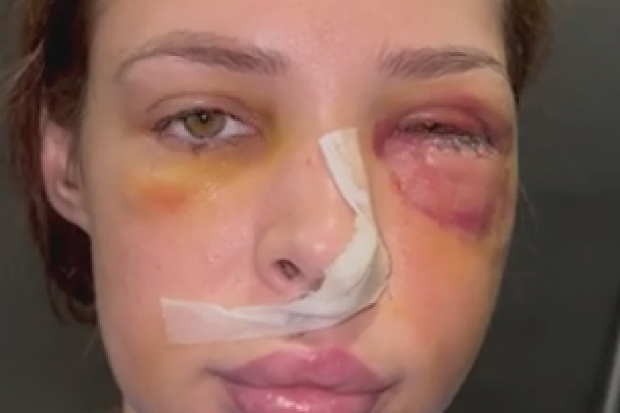 Pretučena Nataša Šavija nakon operacije