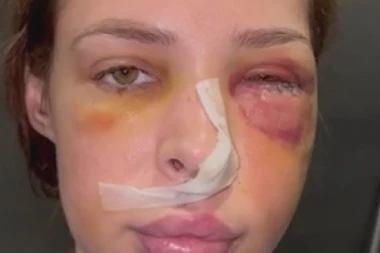 NATAŠA ŠAVIJA ŽIVOTNO UGROŽENA: Rana joj je puna bakterija, strahuje da ne dobije sepsu!