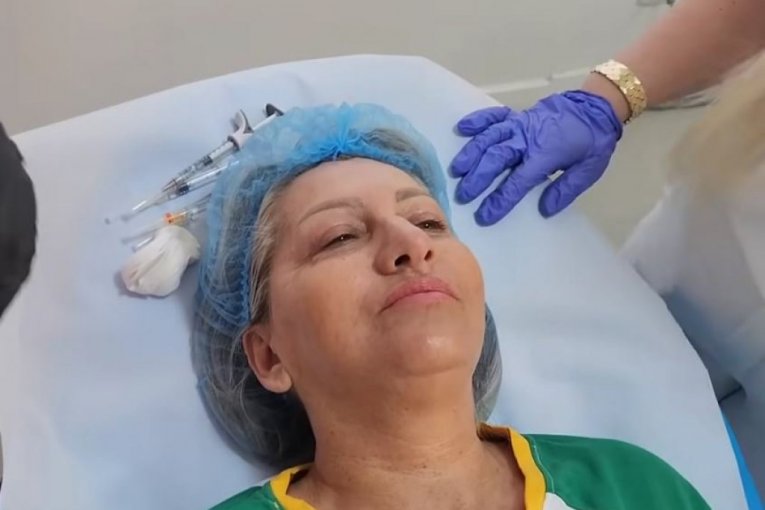 Biljana Dragojević radi botoks lica