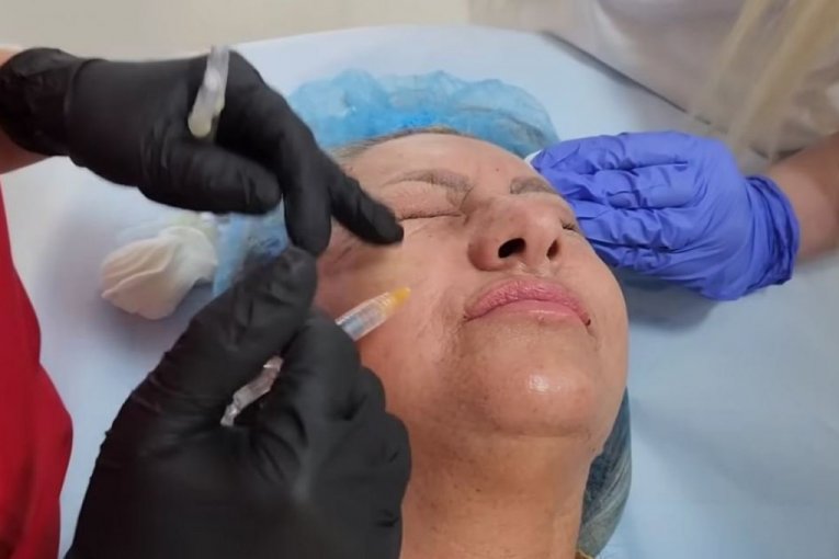 Biljana Dragojević radi botoks lica