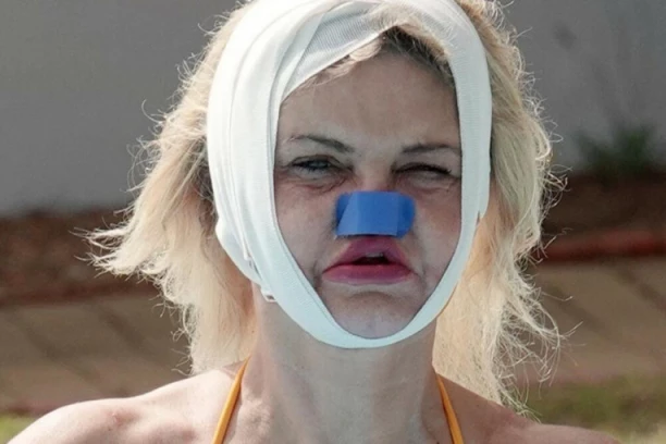 POZNATA GLUMICA SEKLA LOBANJU, KONZUMIRALA KOKAIN, A SADA JOJ TRUNE LICE! Trpi nesnosne bolove! (FOTO)