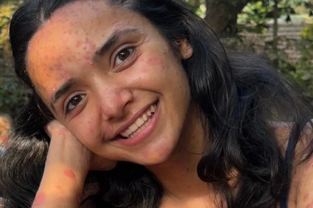 BOLEST JOJ JE ZAHVATILA 95 ODSTO KOŽE: Krvari i ima stalne poteškoće, ali ne odustaje - Evo kako devojka izgleda kada skine sve sa sebe (FOTO)