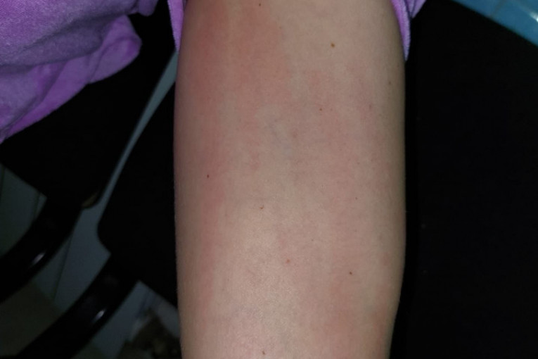 Jelena Radanović u modricama