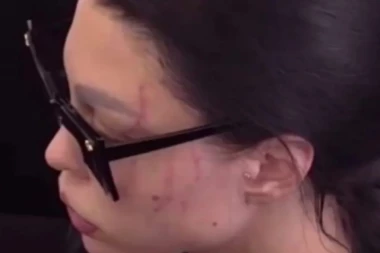 MAJA POKAZALA UNAKAŽENO LICE: Anđela joj promenila lični opis, isplivala fotografija sa povredama!