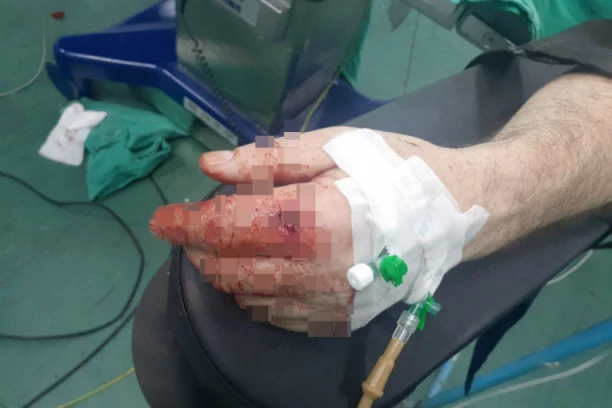 UZNEMIRIJUĆE FOTOGRAFIJE SRBINA RANJENOG NA SEVERU KIM: Krvave ruke Galjaka pogođenog bojevom municijom (FOTO)