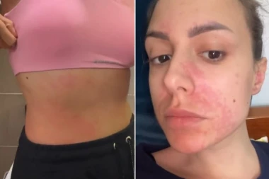 KATARINA JE POJELA SLADOLED, A ONDA JE ZAVRŠILA NA INFUZIJI! Lekari sumnjaju na ovo, ona upozorava "Širi se po telu, sve je gore" (FOTO/VIDEO)
