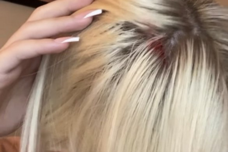 Ruža Rupić sebi "otvorila glavu"