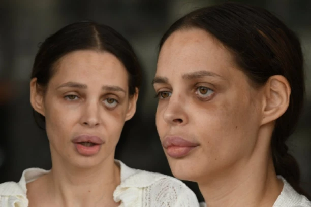 ŠAVIJA PRED OPERACIJU OTKRILA NOVE DETALJE NASILJA: Niko neće da plati da me gleda unakaženu sa ISKRIVLJENIM LICEM!