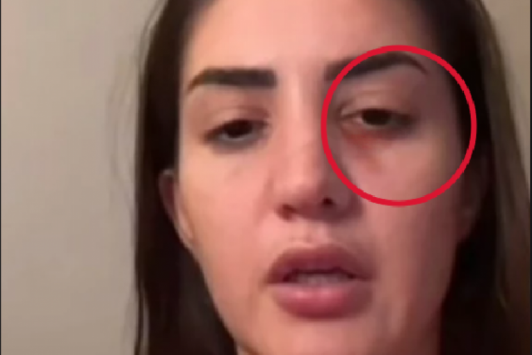 Anđela Đuričić modrica