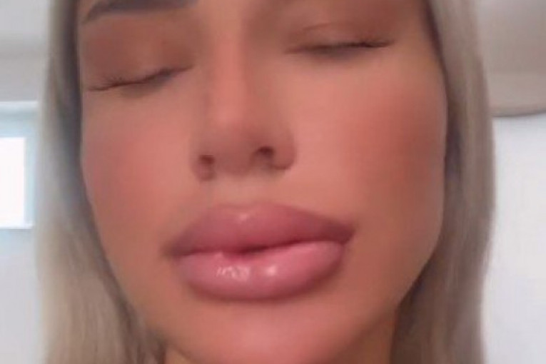 Aleksandra Nikolić ponovo korigovala usta