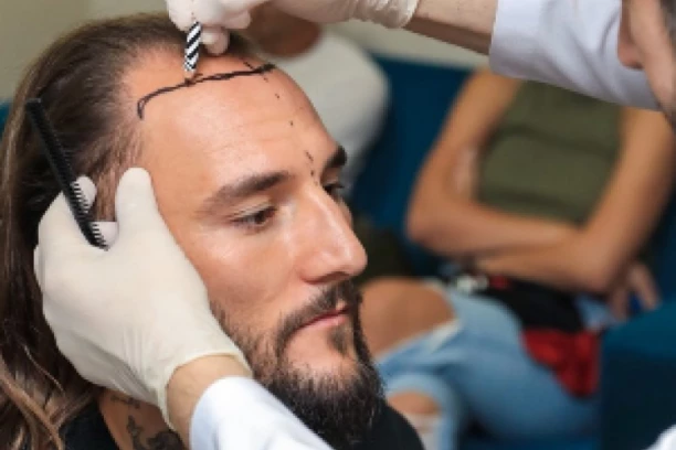 GUDELJ OŠIŠAN SKROZ NA ĆELAVO: Dečko Anastasije Ražnatović zbog operacije morao da prihvati drastičnu razliku, nema više zaštitnog znaka!