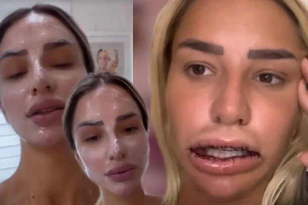 OTIŠLA KOD DOKTORA I ZABORAVILA LICE: Snimak Aleksandre Nikolić FRAPIRAO sve, šta joj se desilo nakon tretmana? (GALERIJA)