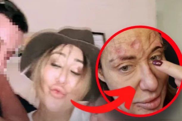 PRVA SLIKA ANE NIKOLIĆ NAKON SKANDALA: Otkriveno stanje pevačice posle snimka sa ŽIVIM RANAMA na licu! (FOTO)