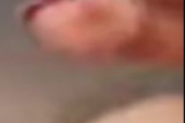 Ana Nikolić, rane po prstima