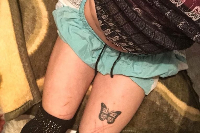 Noa Milivojev samopovređivanje