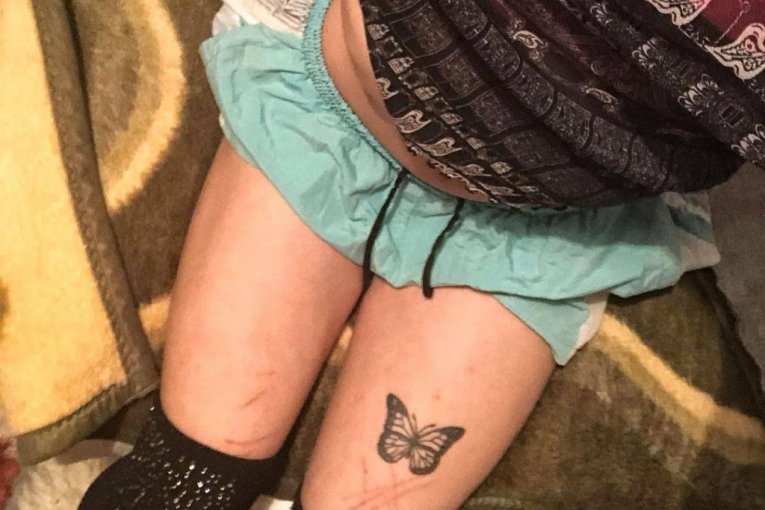 Noa Milivojev rane od samopovređivanja