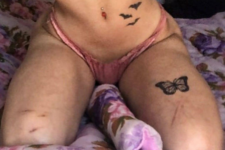 Noa Milivojev posekotine