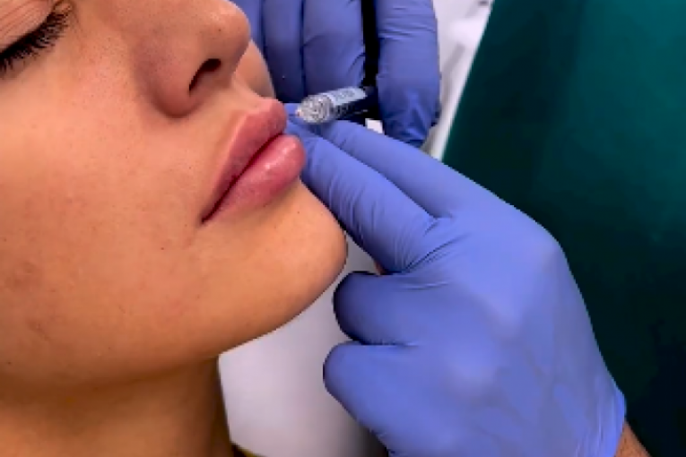 Anđela Đuričić na korekciji usana