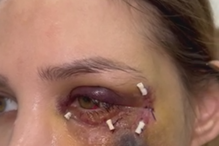 Nataša Šavija nakon druge operacije