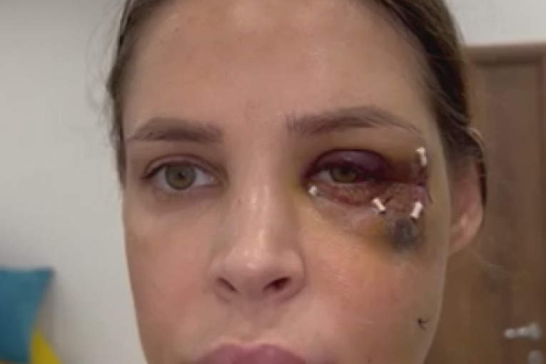 Nataša Šavija nakon druge operacije