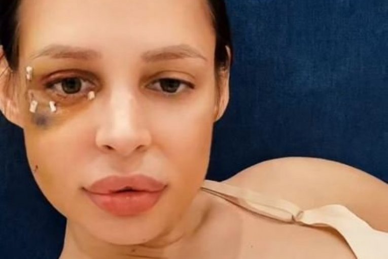 Šavija nakon operacije