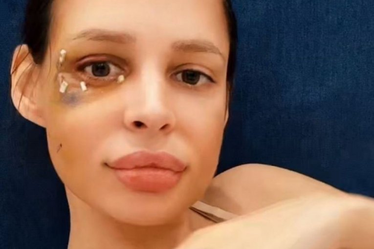 Šavija nakon operacije