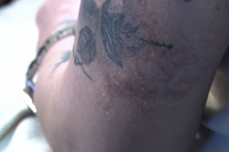 Dušica Jakovljević nakon operacije