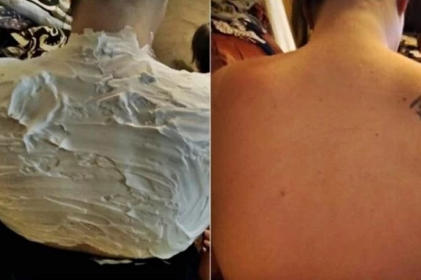 PROIZVOD KOJI SVI IMATE U KUĆI SPAŠAVA OD OPEKOTINA: Ne, nije JOGURT, ovo će vas rešiti jakog crvenila od sunca za pola sata!