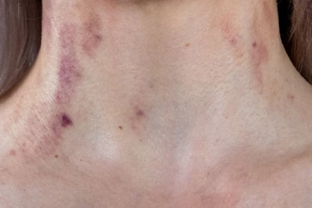 NAKON ŠTO JE PARTNER UGRIZAO ZA VRAT USLEDIO JE PAKAO: 12 sati nakon toga događa se prava BORBA za život, doktor upozorava na OVO!